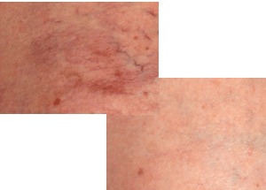 Laserway Clinic Before and After