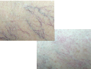 Laserway Clinic Before and After