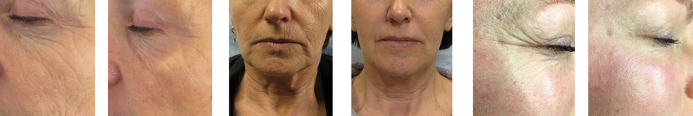 Tixel-before-and-after-2026 Laserway Face and Body Clinic Jersey Tixel